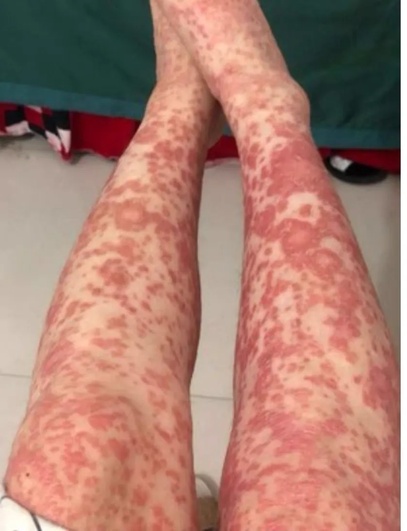 皮膚困擾無法入眠 研究皮膚疾病10年重獲大突破 換膚淨 徹底改變230萬皮膚病患者命運 皮膚困擾無法入眠 研究皮膚疾病10年重獲大突破 換膚淨 徹底改變230萬皮膚病患者命運