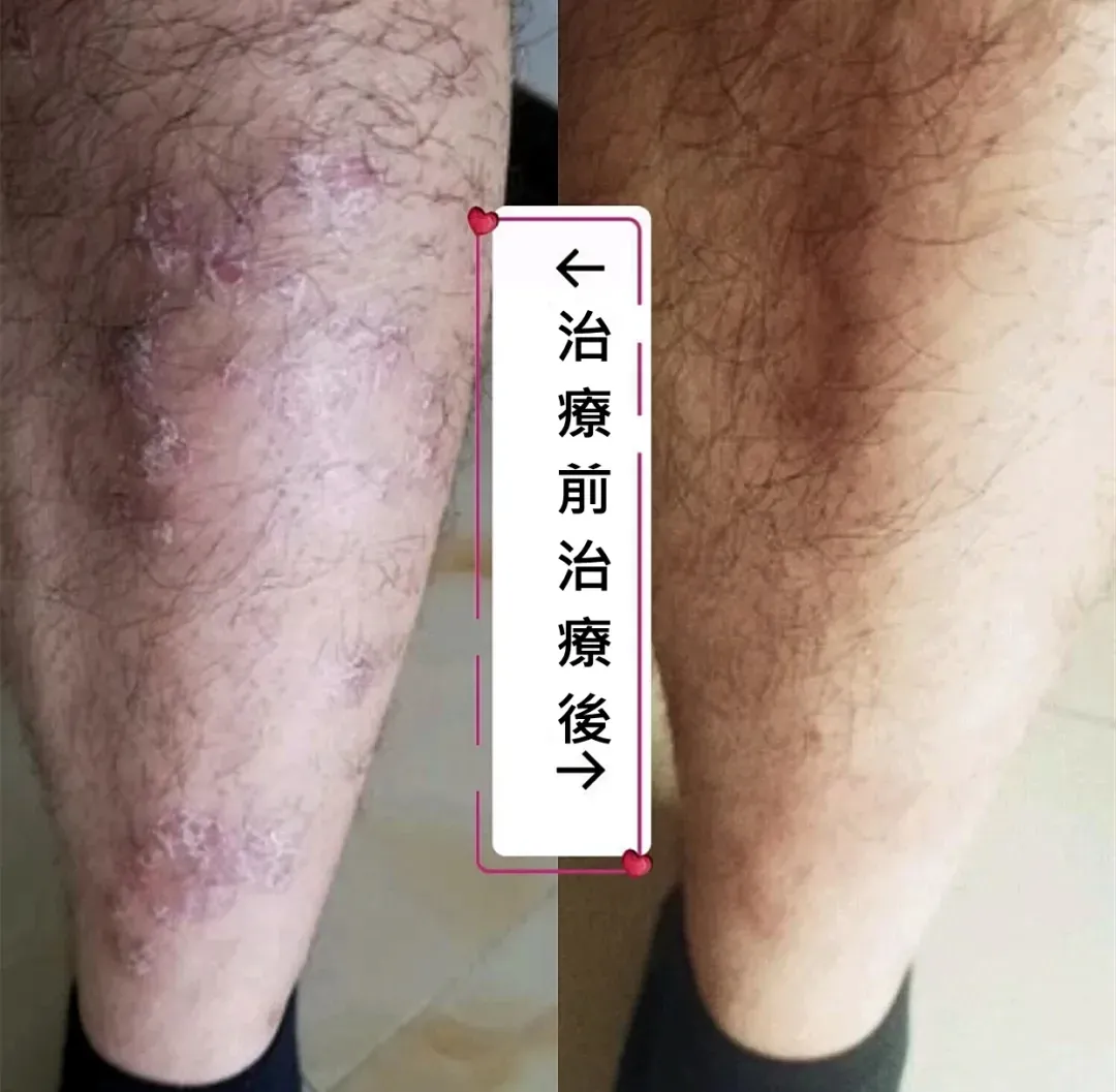 皮膚困擾無法入眠 研究皮膚疾病10年重獲大突破 換膚淨 徹底改變230萬皮膚病患者命運 皮膚困擾無法入眠 研究皮膚疾病10年重獲大突破 換膚淨 徹底改變230萬皮膚病患者命運